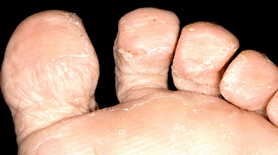 Cómo reconocer la presencia de un hongo entre los dedos de los pies