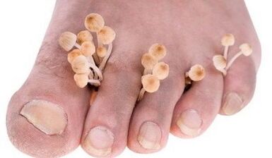 Las razones para el desarrollo del hongo entre los dedos de los pies