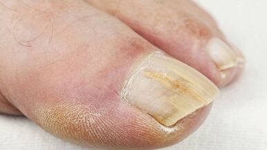 La etapa inicial del desarrollo del hongo en las uñas