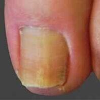 infección de uñas por dermatofitos