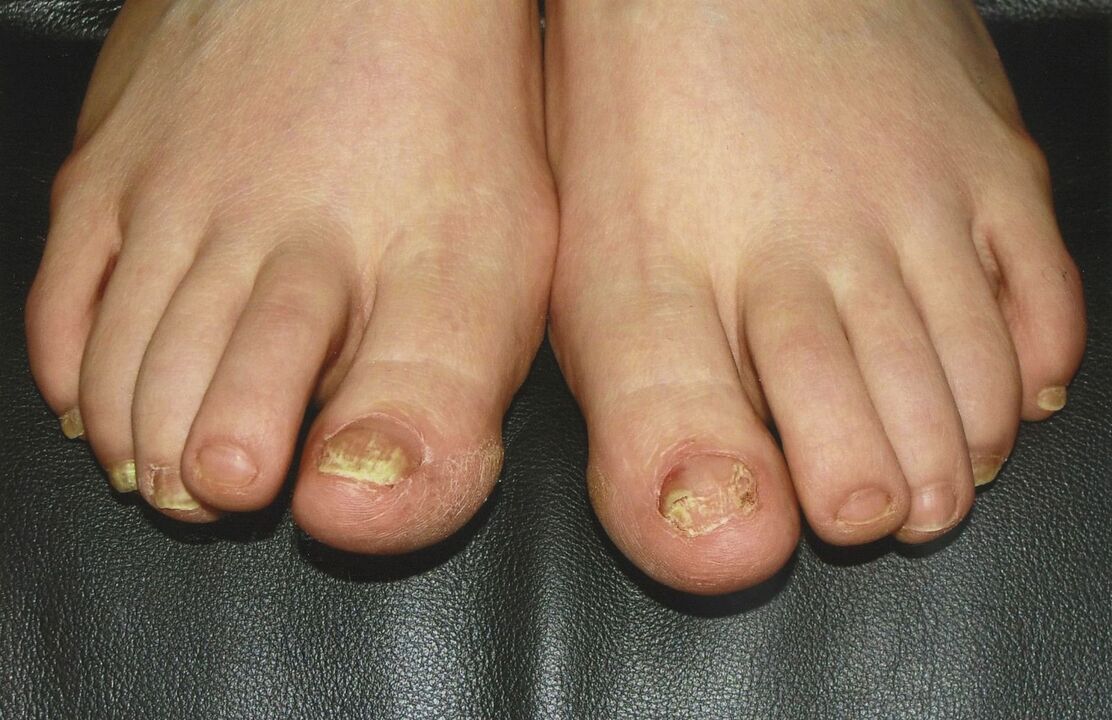 Cómo tratar los hongos en las uñas de los pies con esmalte de uñas.