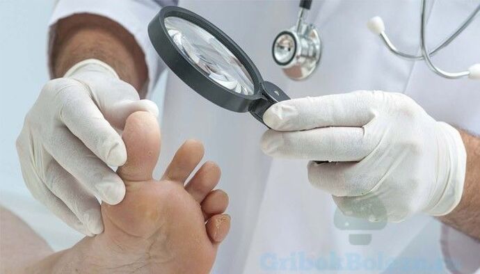 diagnóstico de hongos en los pies por parte de un médico