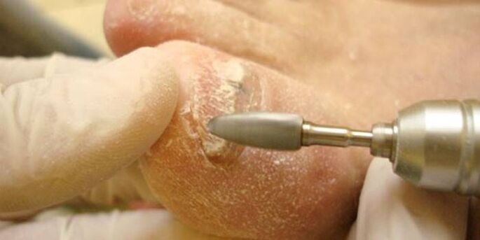 eliminación de hongos en las uñas