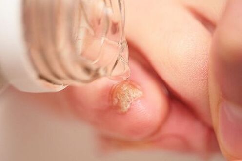 Vinagre de manzana para hongos en las uñas.
