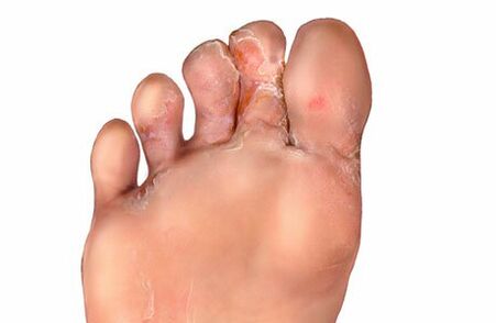 síntomas de hongos entre los dedos de los pies