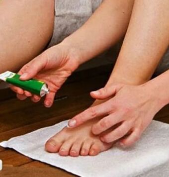 El uso de ungüento terapéutico para la derrota de la uña del dedo gordo del pie con un hongo. 