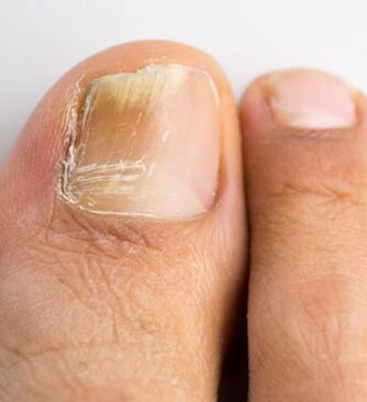 Hongo de la uña en el dedo gordo del pie, que se produce en el contexto de una inmunidad débil