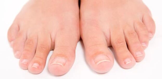 Dedos de los pies con hongos en las uñas