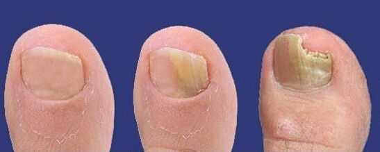 Desarrollo de hongos en las uñas de los pies. 