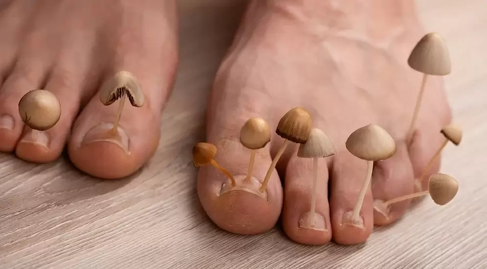 Infección por hongos que afecta las uñas de los pies. 