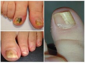 Aspecto de las uñas de los pies con onicomicosis. 