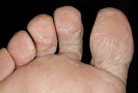 La piel de los pies con una infección por hongos. 
