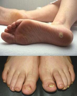Manifestaciones de micosis en la piel y uñas de los pies. 