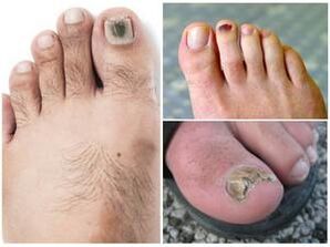 Signos de una infección por hongos en las uñas de los pies