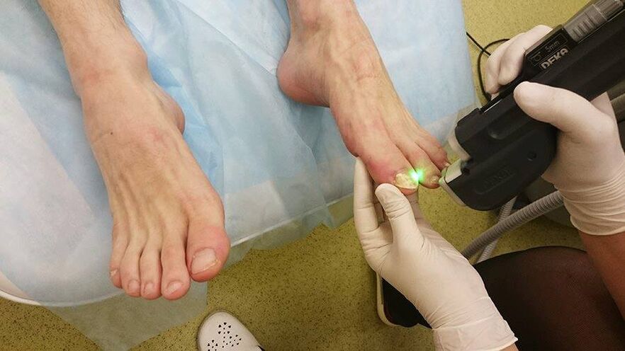Tratamiento con láser para hongos en las uñas de los pies. 