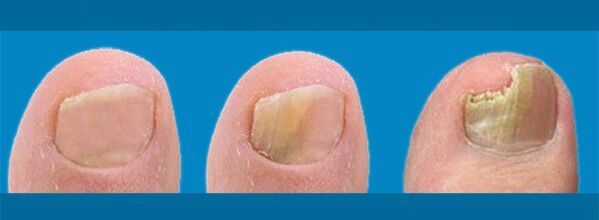 El desarrollo de la onicomicosis hongos en las uñas de los pies. 