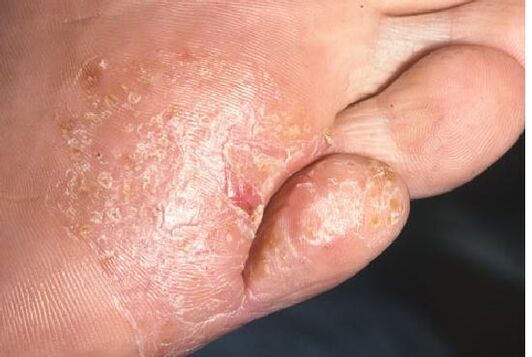 Manifestaciones de una infección por hongos en la piel del pie. 