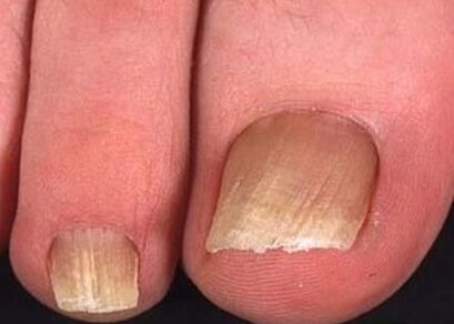 Hongo de uñas en las piernas de la etapa inicial