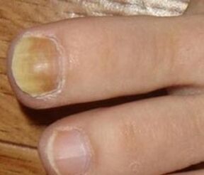 Síntomas de la etapa inicial del hongo de las uñas